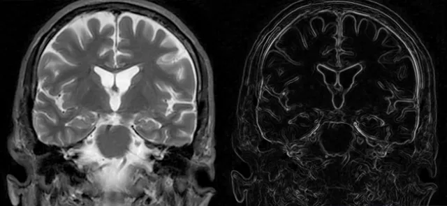 La segmentation d'images